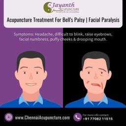 Acupuncture Treatment For Bell's Palsy - Facial Paralysis in Chennai